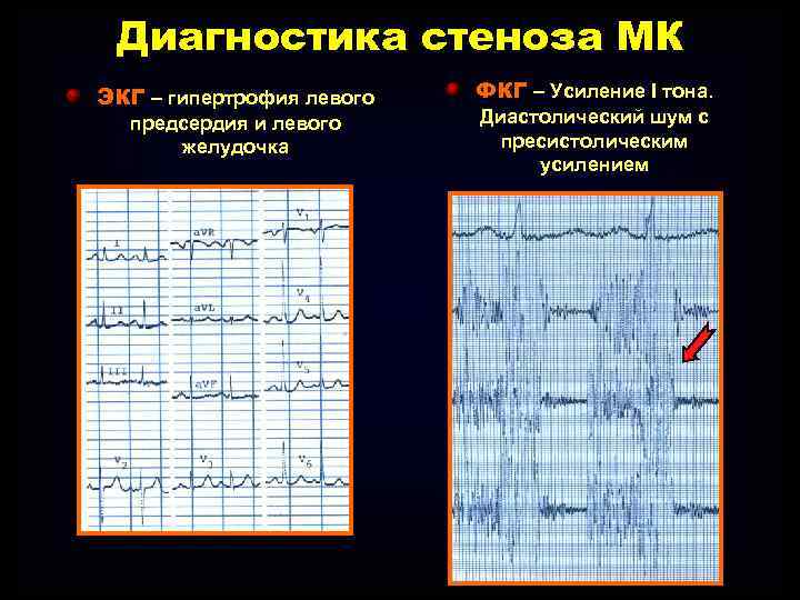 Диагностика стеноза МК ЭКГ – гипертрофия левого предсердия и левого желудочка ФКГ – Усиление