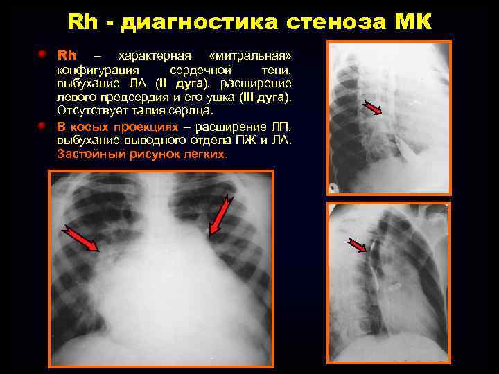 Расширение левой