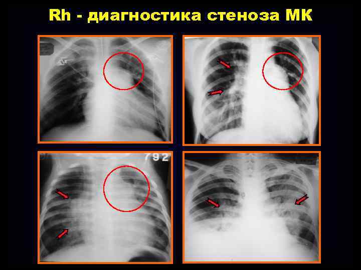 Rh - диагностика стеноза МК 