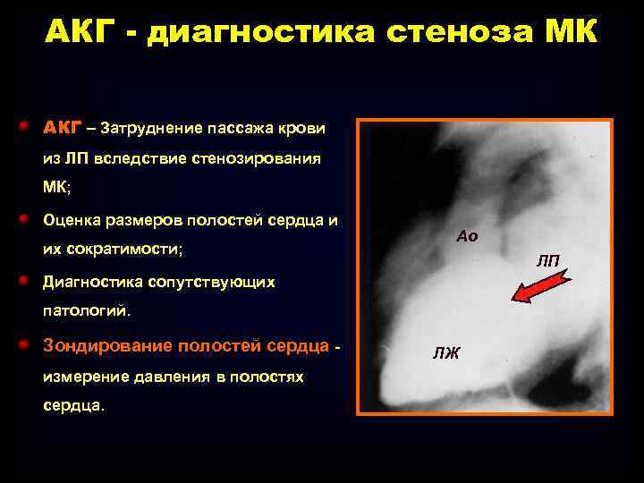 АКГ - диагностика стеноза МК АКГ – Затруднение пассажа крови из ЛП вследствие стенозирования