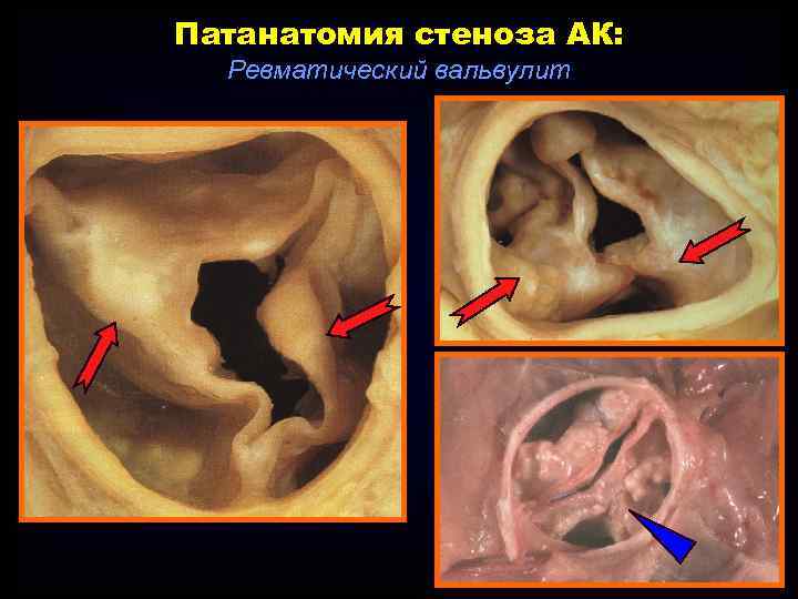 Патанатомия стеноза АК: Ревматический вальвулит 