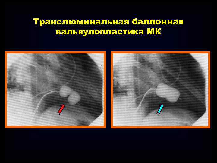 Транслюминальная баллонная вальвулопластика МК 