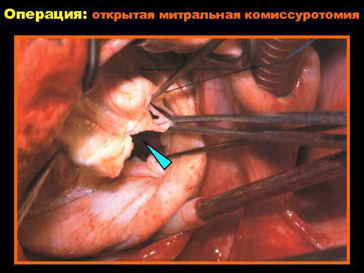 Операция: открытая митральная комиссуротомия 