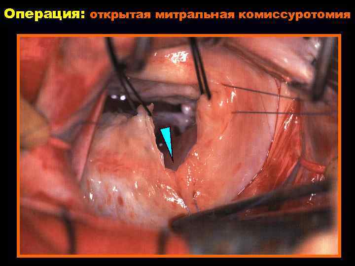 Операция: открытая митральная комиссуротомия 