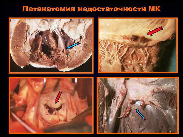 Патанатомия недостаточности МК 