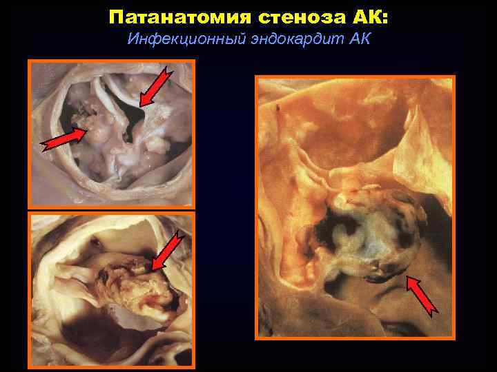 Патанатомия стеноза АК: Инфекционный эндокардит АК 