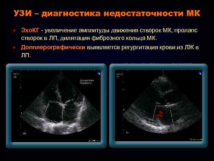 УЗИ – диагностика недостаточности МК Эхо. КГ - увеличение амплитуды движения створок МК, пролапс