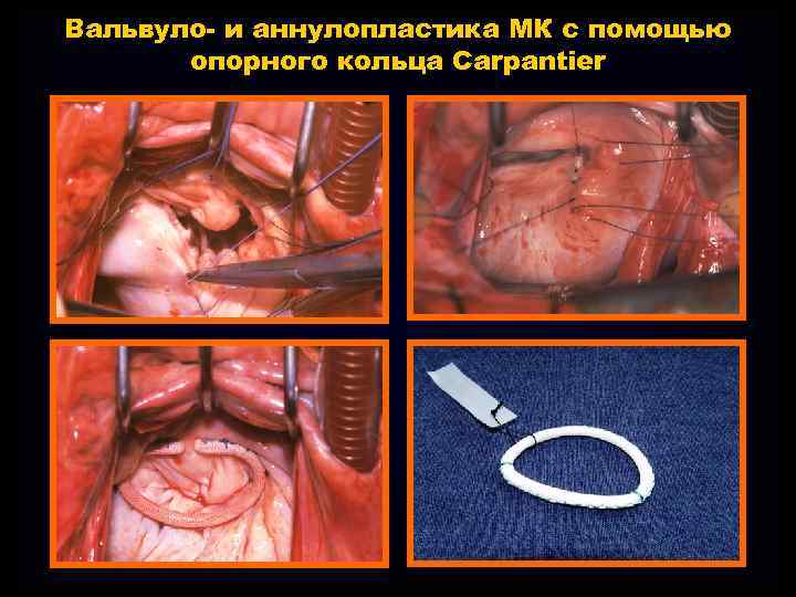 Вальвуло- и аннулопластика МК с помощью опорного кольца Carpantier 