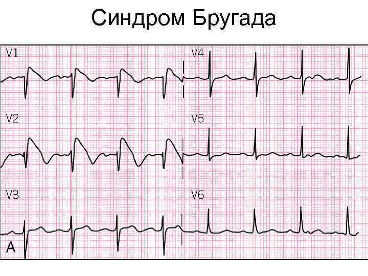 Синдром Бругада 