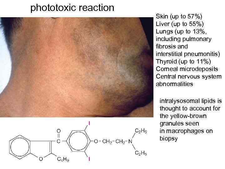 phototoxic reaction Skin (up to 57%) Liver (up to 55%) Lungs (up to 13%,