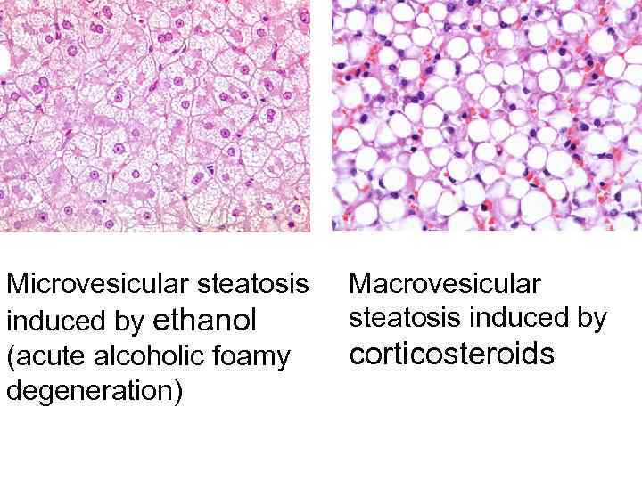 Microvesicular steatosis induced by ethanol (acute alcoholic foamy degeneration) Macrovesicular steatosis induced by corticosteroids