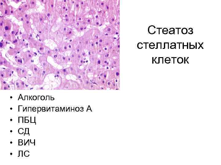 Стеатоз стеллатных клеток • • • Алкоголь Гипервитаминоз А ПБЦ СД ВИЧ ЛС 