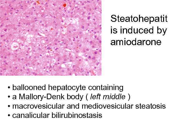 Steatohepatit is induced by amiodarone • ballooned hepatocyte containing • a Mallory-Denk body (