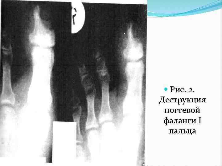  Рис. 2. Деструкция ногтевой фаланги I пальца 