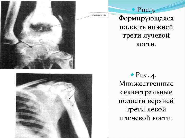  Рис. 3. Формирующаяся полость нижней трети лучевой кости. Рис. 4. Множественные секвестральные полости