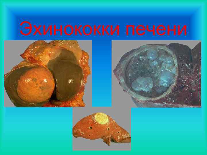 Эхинококки печени 
