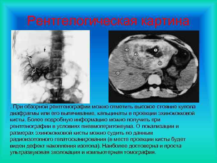 Рентгелогическая картина . При обзорной рентгенографии можно отметить высокое стояние купола диафрагмы или его