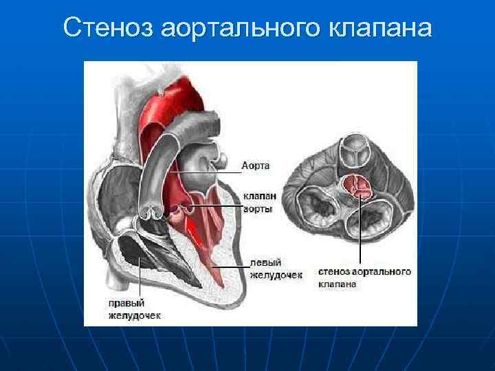 Расхождение створок аортального клапана