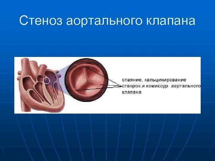 Кальцинат на клапане сердца