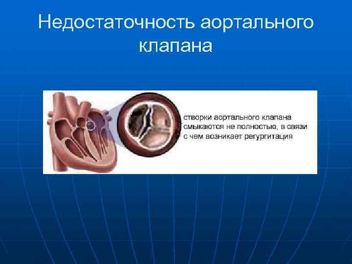 Стеноз аортального клапана симптомы