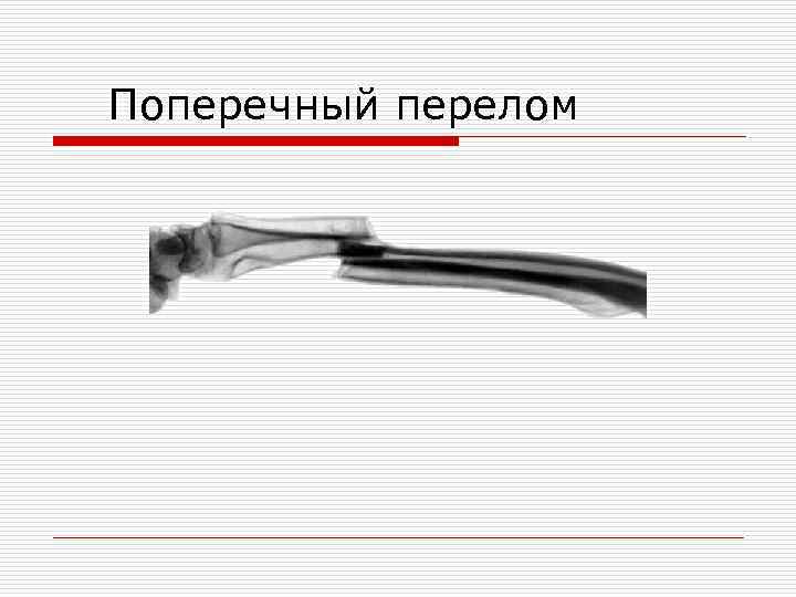 Поперечный перелом 