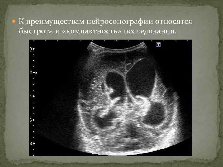  К преимуществам нейросонографии относятся быстрота и «компактность» исследования. 