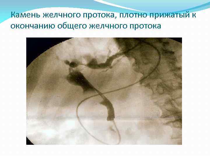 Камень желчного протока, плотно прижатый к окончанию общего желчного протока 