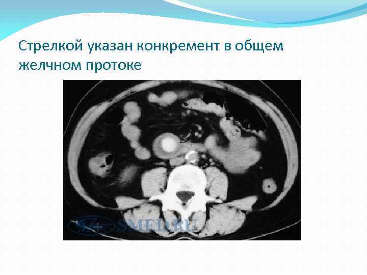 Стрелкой указан конкремент в общем желчном протоке 