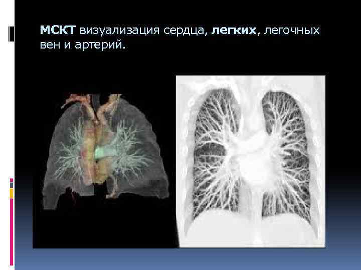 МСКТ визуализация сердца, легких, легочных вен и артерий. 