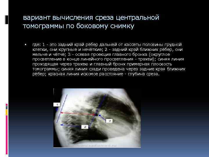 вариант вычисления среза центральной томограммы по боковому снимку где: 1 - это задний край
