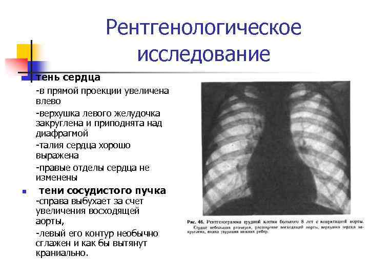 Рентгенологическое исследование n тень сердца -в прямой проекции увеличена влево -верхушка левого желудочка закруглена
