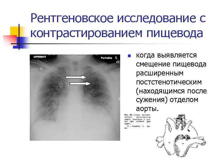 Рентгеновское исследование с контрастированием пищевода n когда выявляется смещение пищевода расширенным постстенотическим (находящимся после