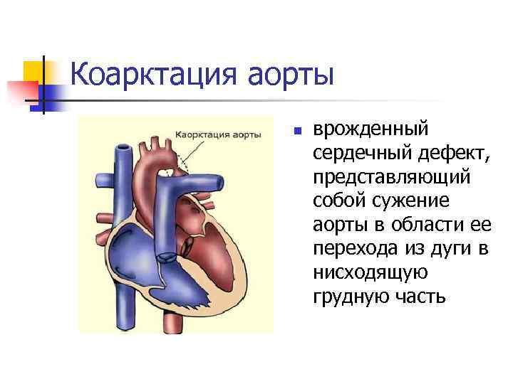 Коарктация аорты n врожденный сердечный дефект, представляющий собой сужение аорты в области ее перехода