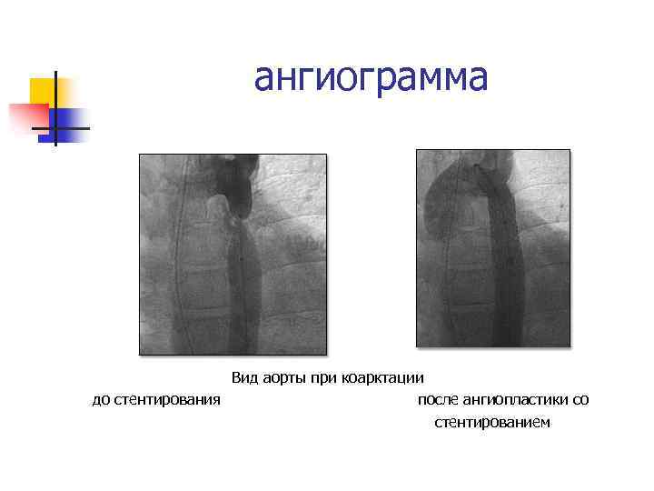 ангиограмма Вид аорты при коарктации до стентирования после ангиопластики со стентированием 