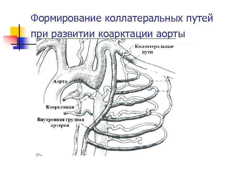 Формирование коллатеральных путей при развитии коарктации аорты 