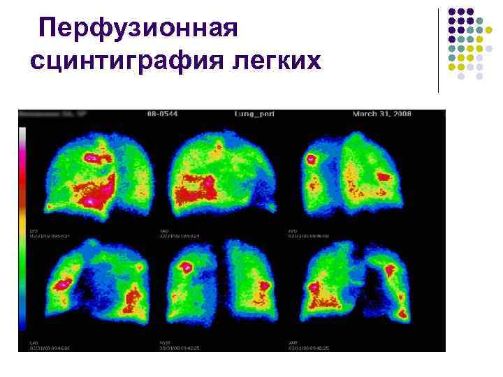 Перфузионная сцинтиграфия легких 