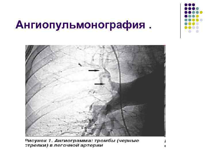 Ангиопульмонография. 