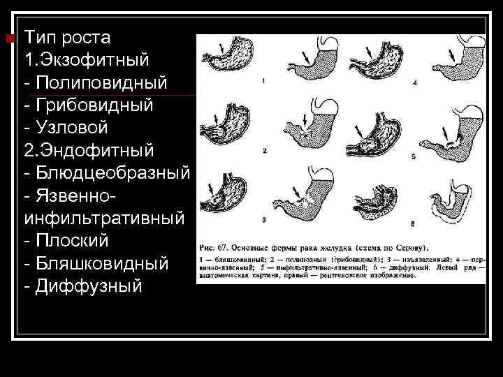 Эндофитный рост опухоли рисунок