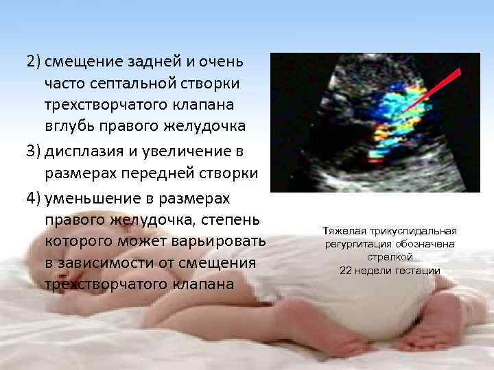 2) смещение задней и очень часто септальной створки трехстворчатого клапана вглубь правого желудочка 3)