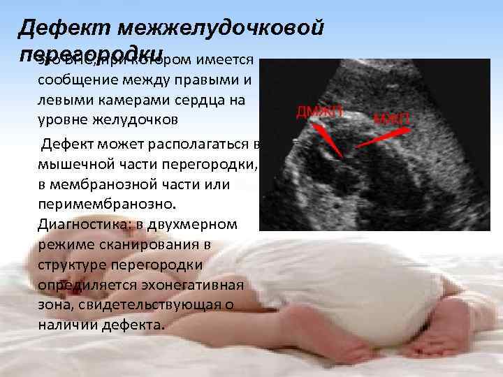 Дефект межжелудочковой перегородки это ВПС, при котором имеется сообщение между правыми и левыми камерами