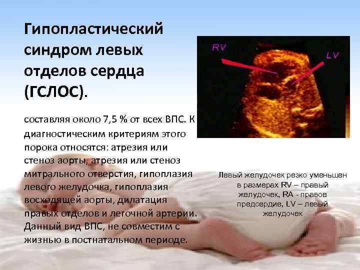 Гипопластический синдром левых отделов сердца (ГСЛОС). составляя около 7, 5 % от всех ВПС.