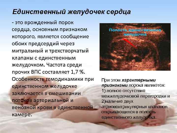 Единственный желудочек сердца - это врожденный порок сердца, основным признаком которого, является сообщение обоих