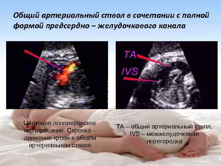 Общий артериальный ствол в сочетании с полной формой предсердно – желудочкового канала Цветовое допплеровское