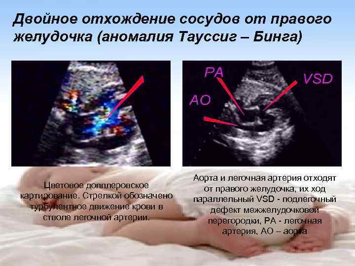 Двойное отхождение сосудов от правого желудочка (аномалия Тауссиг – Бинга) Цветовое допплеровское картирование. Стрелкой
