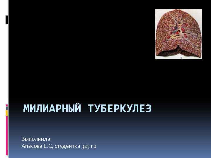 МИЛИАРНЫЙ ТУБЕРКУЛЕЗ Выполнила: Апасова Е. С, студентка 323 гр 