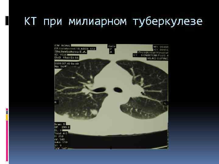 КТ при милиарном туберкулезе 