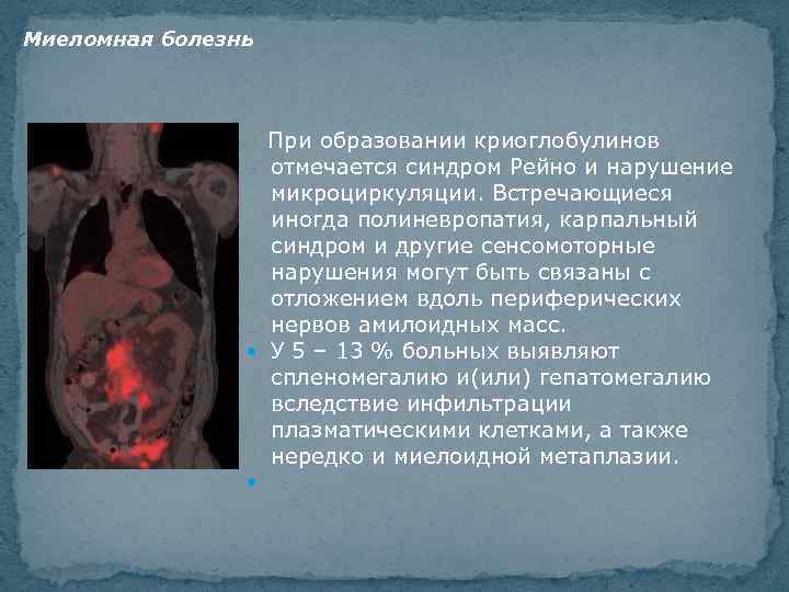 Миеломная болезнь При образовании криоглобулинов отмечается синдром Рейно и нарушение микроциркуляции. Встречающиеся иногда полиневропатия,