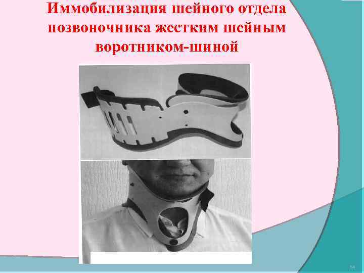 Иммобилизация шейного отдела позвоночника жестким шейным воротником-шиной 14 