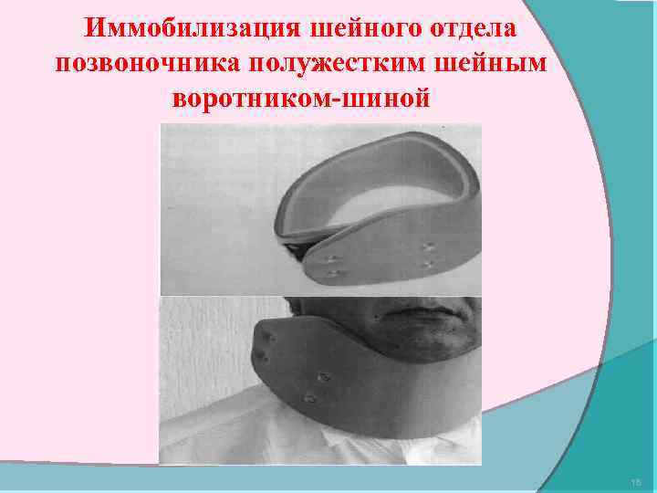 Иммобилизация шейного отдела позвоночника полужестким шейным воротником-шиной 15 
