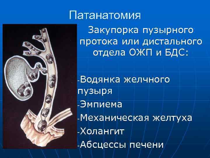 Патанатомия Закупорка пузырного протока или дистального отдела ОЖП и БДС: Водянка желчного пузыря -Эмпиема